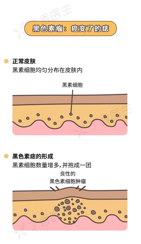 腋下長痣|痣也可能会癌变！长在 3 个地方要注意